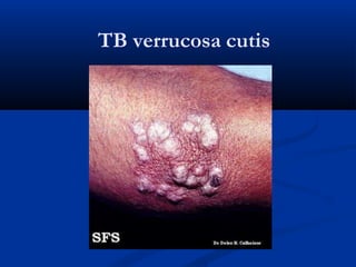 TB verrucosa cutis
 