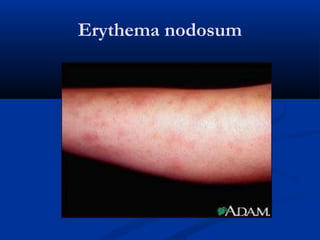 Erythema nodosum
 