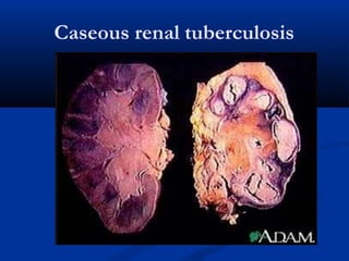 Caseous renal tuberculosis
 