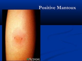 Positive Mantoux
 