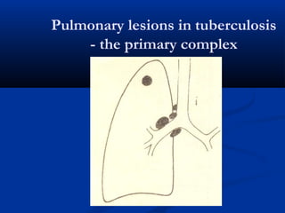 Pulmonary lesions in tuberculosis
- the primary complex
 