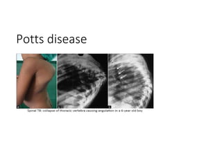 Potts disease
 