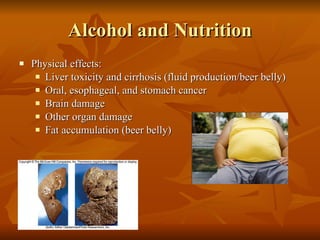 Alcohol and Nutrition Physical effects: Liver toxicity and cirrhosis (fluid production/beer belly) Oral, esophageal, and stomach cancer Brain damage Other organ damage Fat accumulation (beer belly) 