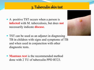3. Tuberculin skin test
 A positive TST occurs when a person is
infected with M. tuberculosis, but does not
necessarily indicate disease.
 TST can be used as an adjunct in diagnosing
TB in children with signs and symptoms of TB
and when used in conjunction with other
diagnostic tests.
 Mantoux test is the recommended method
done with 2 TU of tuberculin PPD RT23.
 