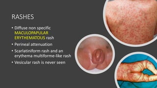 Childhood vasculitis - KD, HSP and other vasculitic syndromes | PPTX