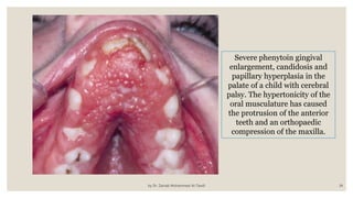 by Dr. Zainab Mohammed Al-Tawili 34
Severe phenytoin gingival
enlargement, candidosis and
papillary hyperplasia in the
palate of a child with cerebral
palsy. The hypertonicity of the
oral musculature has caused
the protrusion of the anterior
teeth and an orthopaedic
compression of the maxilla.
 