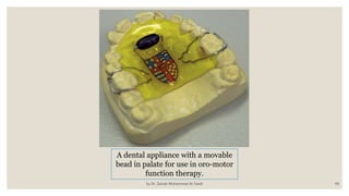 by Dr. Zainab Mohammed Al-Tawili 49
A dental appliance with a movable
bead in palate for use in oro-motor
function therapy.
 