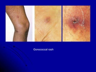 Gonococcal rash 