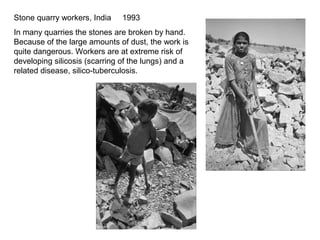 Stone quarry workers, India    1993
In many quarries the stones are broken by hand.
Because of the large amounts of dust, the work is
quite dangerous. Workers are at extreme risk of
developing silicosis (scarring of the lungs) and a
related disease, silico-tuberculosis.
 