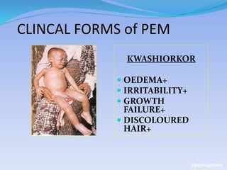 CLINCAL FORMS of PEM
KWASHIORKOR
 OEDEMA+
 IRRITABILITY+
 GROWTH
FAILURE+
 DISCOLOURED
HAIR+
Vijayaraghavan
 
