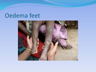 Oedema feet
 