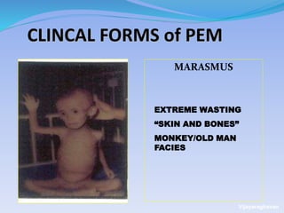 CLINCAL FORMS of PEM
MARASMUS
EXTREME WASTING
“SKIN AND BONES”
MONKEY/OLD MAN
FACIES
Vijayaraghavan
 