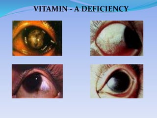 VITAMIN - A DEFICIENCY
 