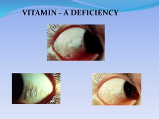 VITAMIN - A DEFICIENCY
 