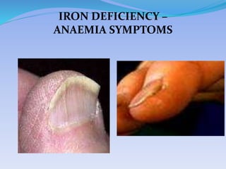 IRON DEFICIENCY –
ANAEMIA SYMPTOMS
 