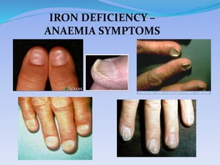 IRON DEFICIENCY –
ANAEMIA SYMPTOMS
 