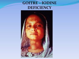 GOITRE – IODINE
DEFICIENCY
 