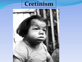 Cretinism
 