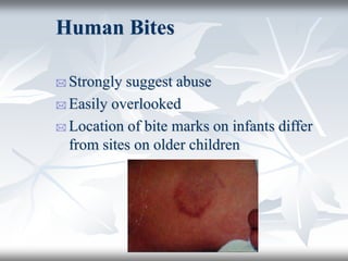 Human Bites
 Strongly suggest abuse
 Easily overlooked
 Location of bite marks on infants differ
from sites on older children
 