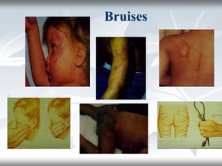 Bruises
 