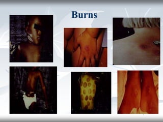 Burns
 