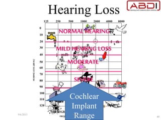 Hearing Loss
Cochlear
Implant
Range9/6/2015 Manfred Stoifl
40
 