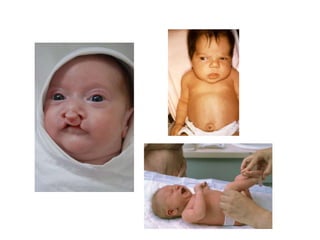 Children with disabilities | PPTX