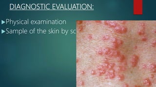 DIAGNOSTIC EVALUATION:
Physical examination
Sample of the skin by scarping
 