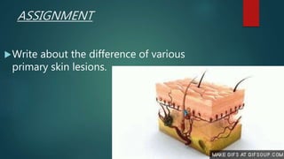 ASSIGNMENT
Write about the difference of various
primary skin lesions.
 