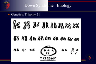 Down Syndrome  Etiology Genetics: Trisomy 21 