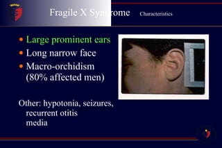 Fragile X Syndrome  Characteristics Large prominent ears Long narrow face Macro-orchidism (80% affected men) Other: hypotonia, seizures, recurrent otitis  media 