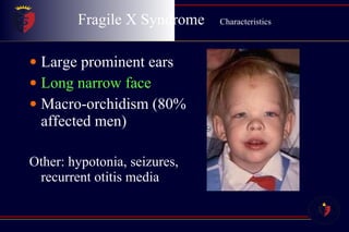 Fragile X Syndrome  Characteristics Large prominent ears Long narrow face Macro-orchidism (80% affected men) Other: hypotonia, seizures, recurrent otitis media 