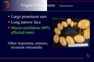Fragile X Syndrome  Characteristics Large prominent ears Long narrow face Macro-orchidism (80% affected men) Other: hypotonia, seizures, recurrent otitis media 
