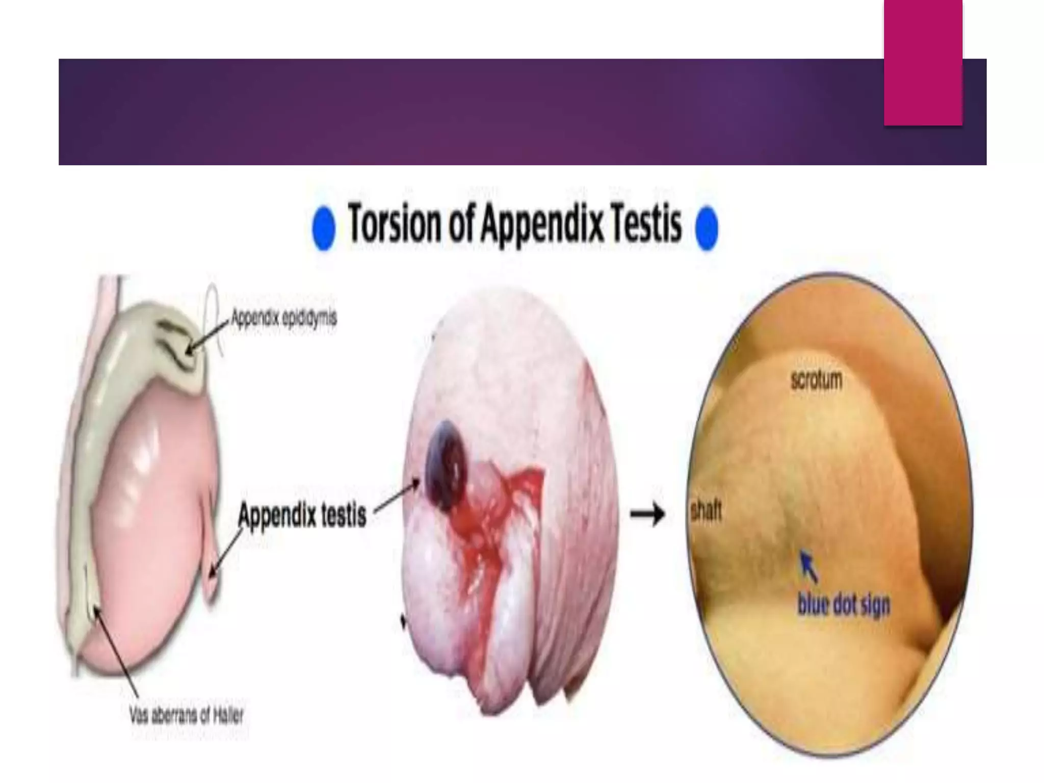 Child with acute scrotum | PPTX