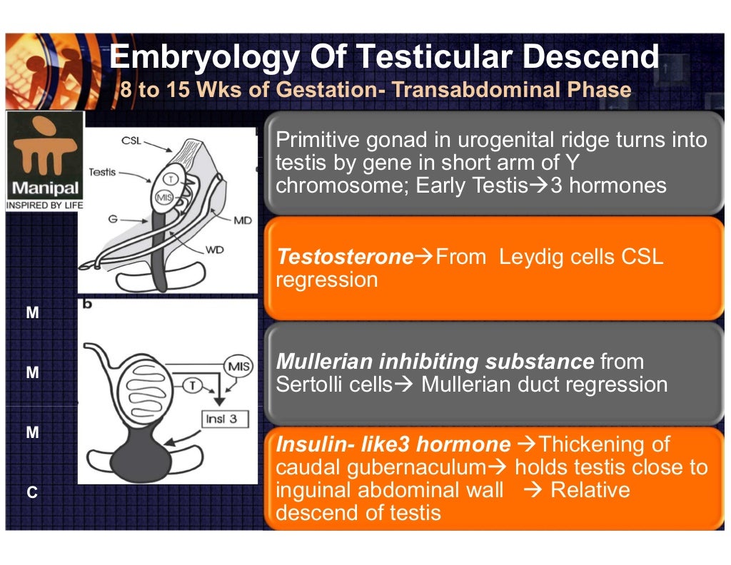 Cryptorchidism(Undescended testis)