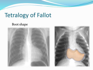 Tetralogy of Fallot 
Boot shape 
 