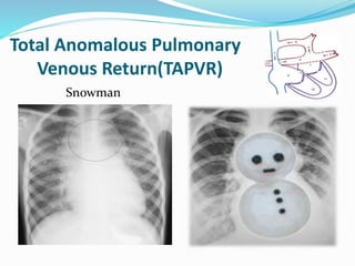 Total Anomalous Pulmonary 
Venous Return(TAPVR) 
Snowman 
 