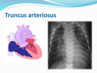 Truncus arteriosus 
 