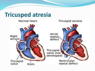 Tricusped atresia 
 