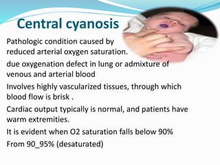 Central cyanosis 
Pathologic condition caused by 
reduced arterial oxygen saturation. 
due oxygenation defect in lung or admixture of 
venous and arterial blood 
Involves highly vascularized tissues, through which 
blood flow is brisk . 
Cardiac output typically is normal, and patients have 
warm extremities. 
It is evident when O2 saturation falls below 90% 
From 90_95% (desaturated) 
 