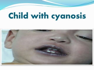 Child with cyanosis 
 
