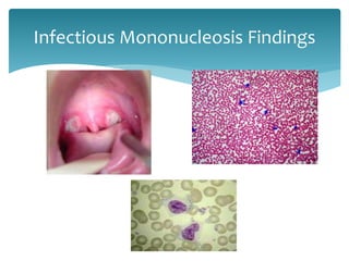 Infectious Mononucleosis Findings
 