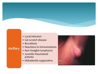 • Local infection
• Cat scratch disease
• Brucellosis
• Reactions to immunizations
• Non Hodgkin lymphoma
• Juvenile rheumatoid
arthritis
• Hidradenitis suppurativa
Axillary
 