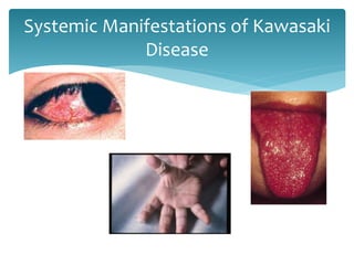 Systemic Manifestations of Kawasaki
Disease
 