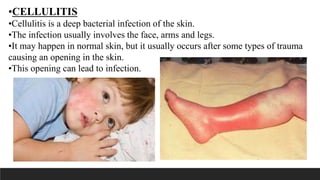 Deep Cellulitis Example Child with skin disorder | PPTX