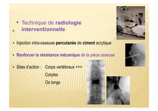 Corps vertébraux +++
Cotyles
Os longs
Sites d’action :
Renforcer la résistance mécanique de la pièce osseuse
Injection intra-osseuse percutanée de ciment acrylique
 