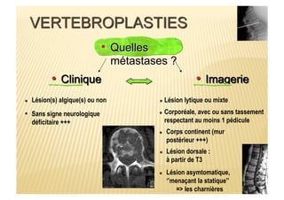 Lésion(s) algique(s) ou non
Sans signe neurologique
déficitaire +++
Lésion lytique ou mixte
Corporéale, avec ou sans tassement
respectant au moins 1 pédicule
Corps continent (mur
postérieur +++)
Lésion dorsale :
à partir de T3
Lésion asymtomatique,
‘’menaçant la statique’’
=> les charnières
 