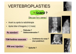 Dès que l’on y pense !
Avant ou après la radiothérapie
Après bilan d’imagerie (< 2 mois)
Rx standard
TDM fenêtres osseuses
IRM avec injection
Pédicules ?
Ostéocondensation ?
Continence du corps ?
(mur postérieur)
Epidurite ?
 