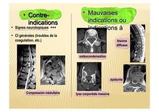 Signes neurologiques +++
CI générales (troubles de la
coagulation, etc.)
lyse corporéale massive
ostéocondensation
épidurite
Compression médullaire
lésions
diffuses
 