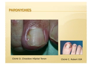 Cliché O. Chosidow Hôpital Tenon Cliché C. Robert IGR
 